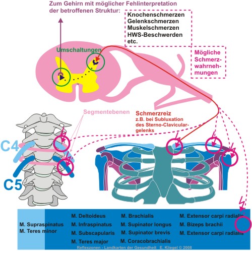 Reflexzonen - Übertragener Schmerz - referred pain